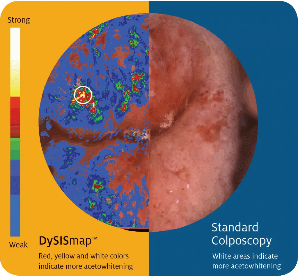 DySIS Cervical Cancer Screening Map